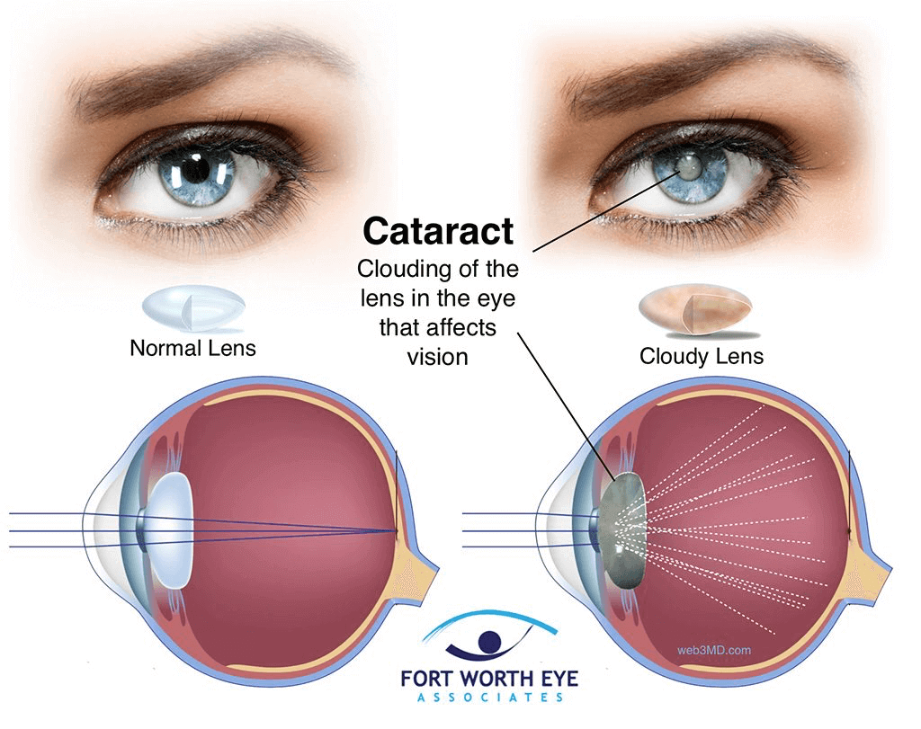 Human Eye and Defects
