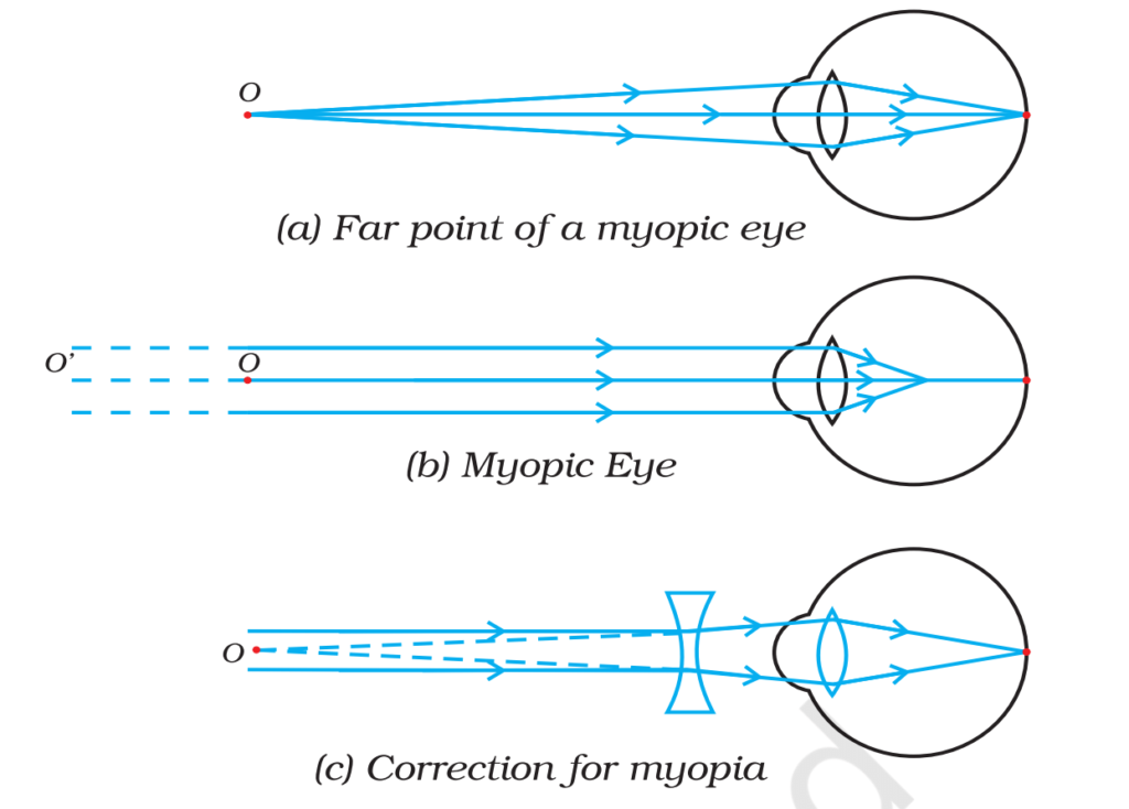 Human Eye and Defects