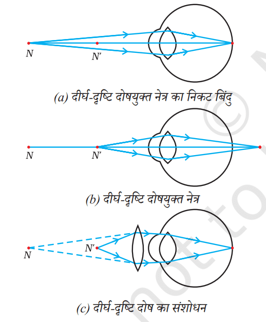मानव नेत्र और दोष
