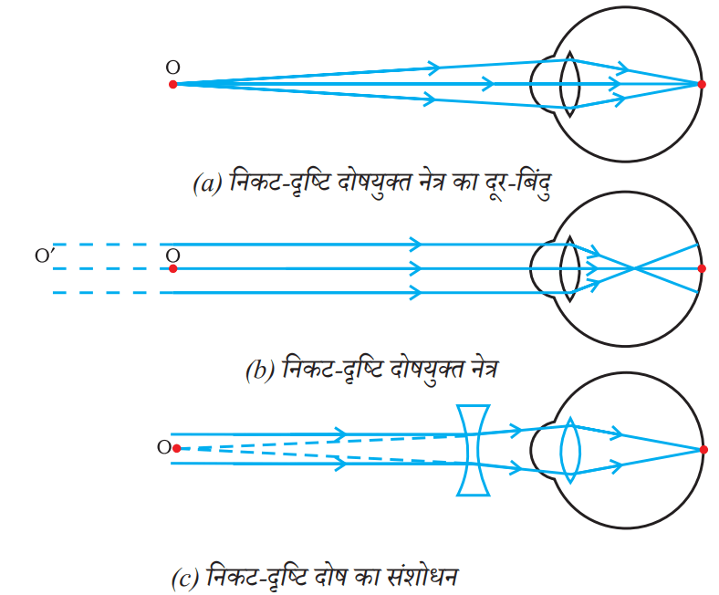 मानव नेत्र और दोष